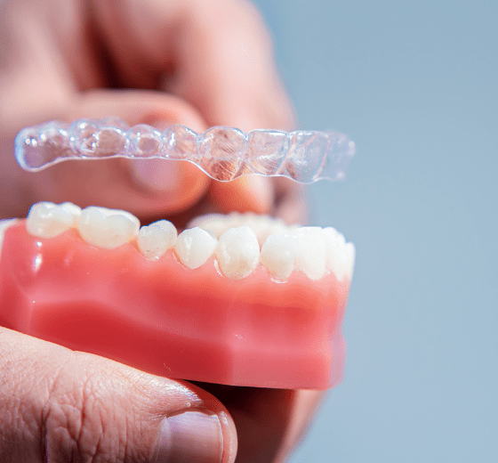 About Aligners, Everything About Aligners, What Are Aligners